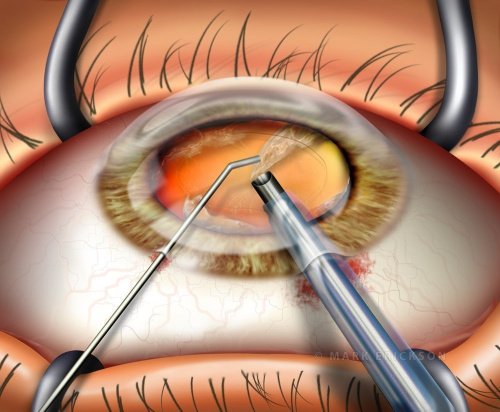 Phacoemulsification of lens nucleus in cataract surgery