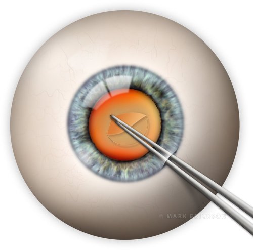 Continuous tear capsulotomy in cataract surgery
