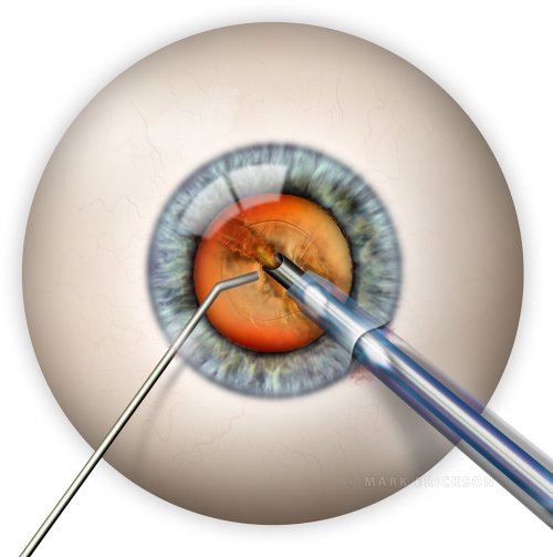 Phacoemulsification in cataract surgery