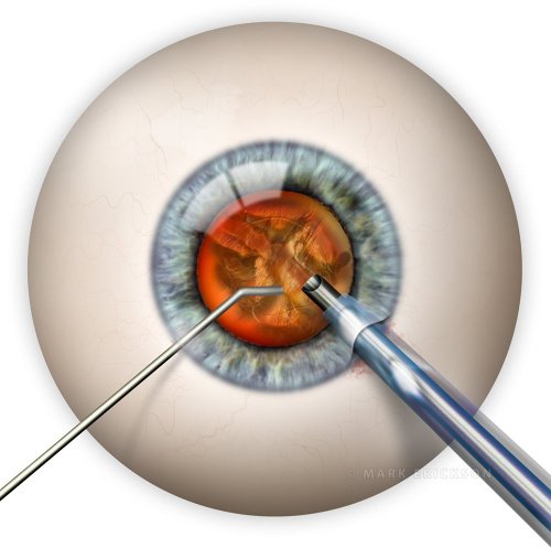 Phacoemulsification ultrasound of a cataract