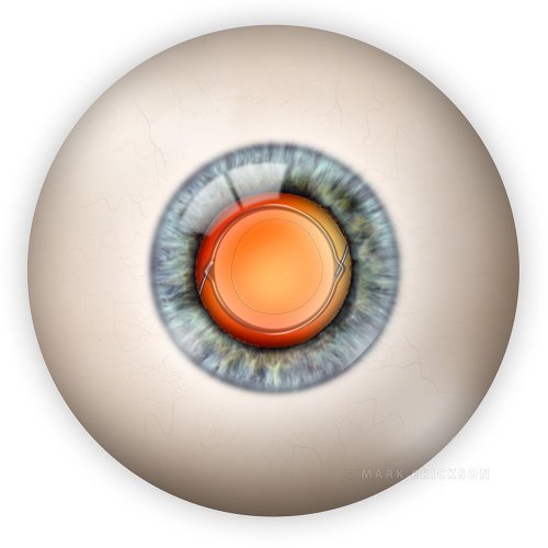 Intraocular lens implant