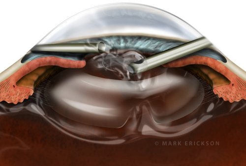 Anterior chamber vitrectomy