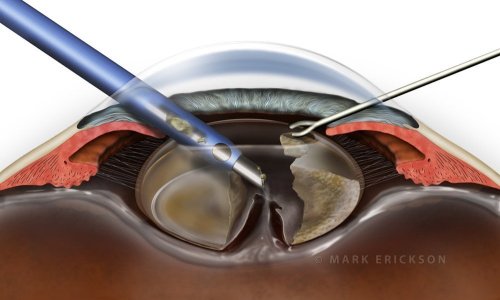 Ruptured posterior capsule during phaco cataract surgery