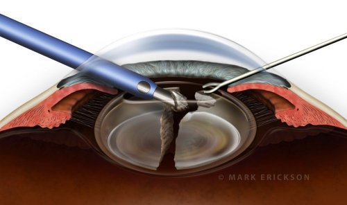 Phaco cataract surgery cross section