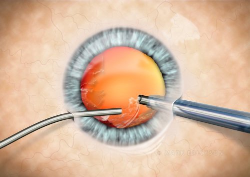 Phaco cortical material removal