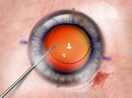 Toric IOL axis positioning