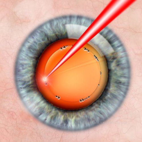 Laser cataract surgery capsulotomy
