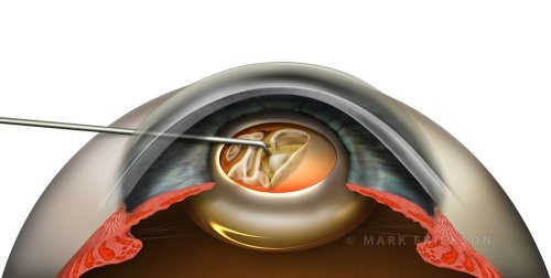 Removing capsulotomy tear material