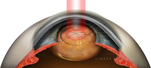 Femtosecond fragmentation of cataract lens