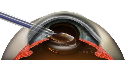 IOL lens implantation in cataract surgery