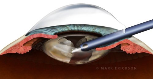 Phaco cross section cataract surgery illustration