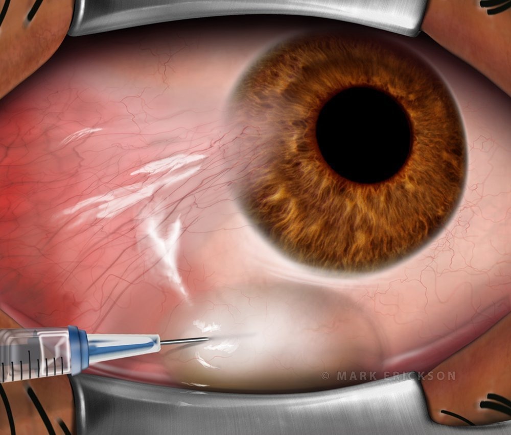 Anesthesia in pterygium removal surgery step 2