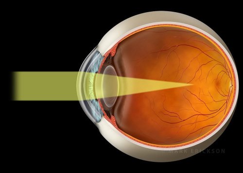 Myopia light rays schematic illustration of a myopic eye