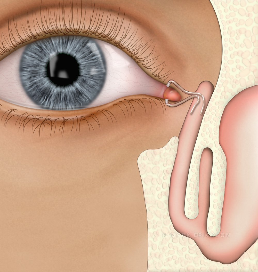 Lacrimal tube implants