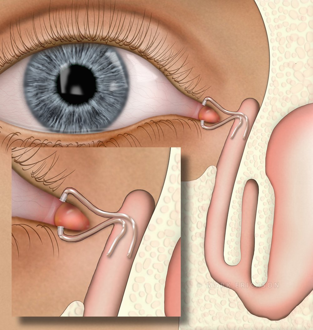 Nasolacrimal tube implant illustration