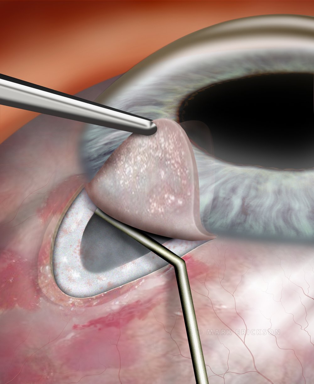 Glaucoma filtering procedure