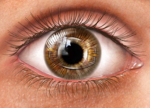 Iris fixated IOL, intraocular lens implant