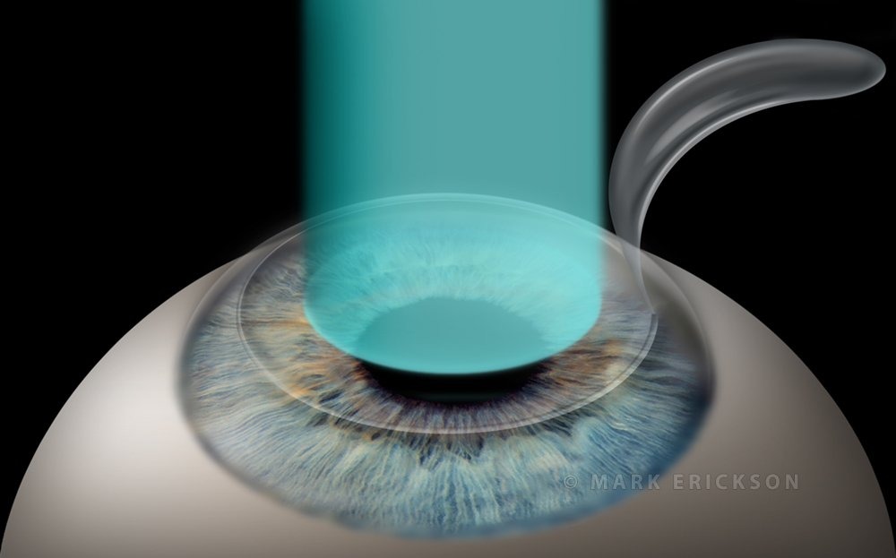 LASIK on a myopic eye