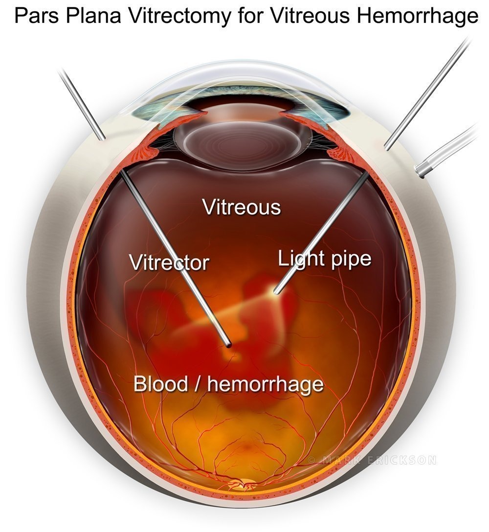 Pars Plana Surgery Procedure Retina Coding Series PFYUZ