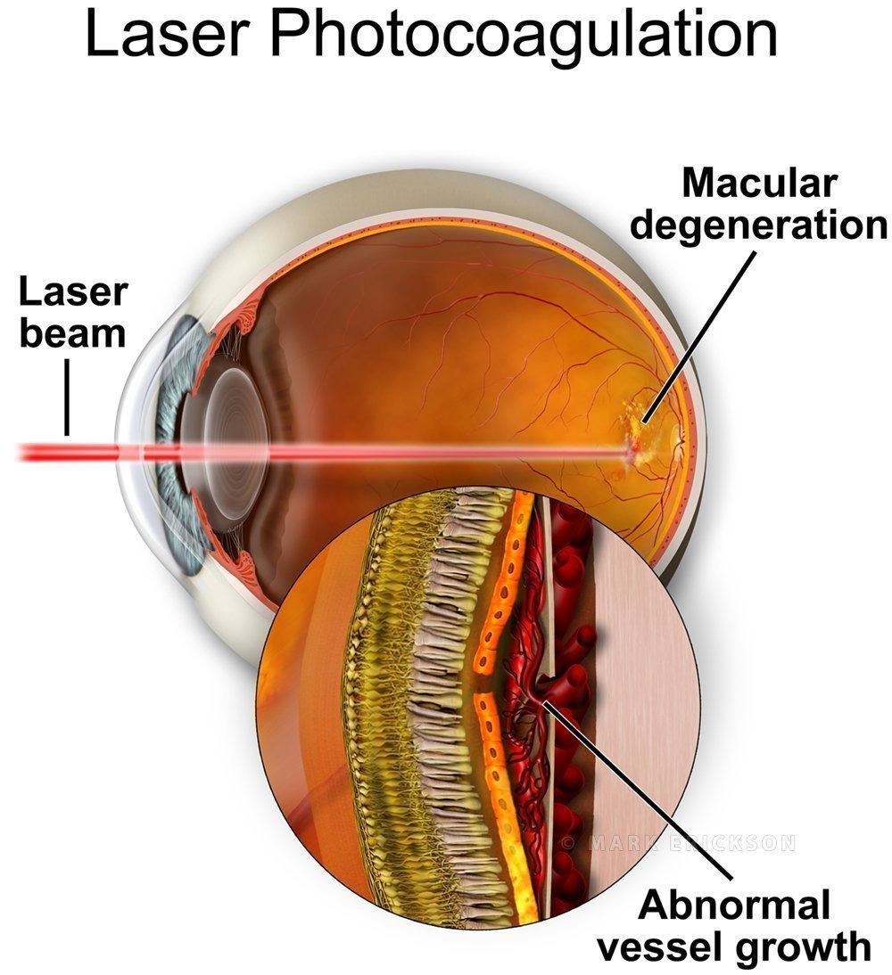Focal argon laser photocoagulation on wet macular degeneration cnvm
