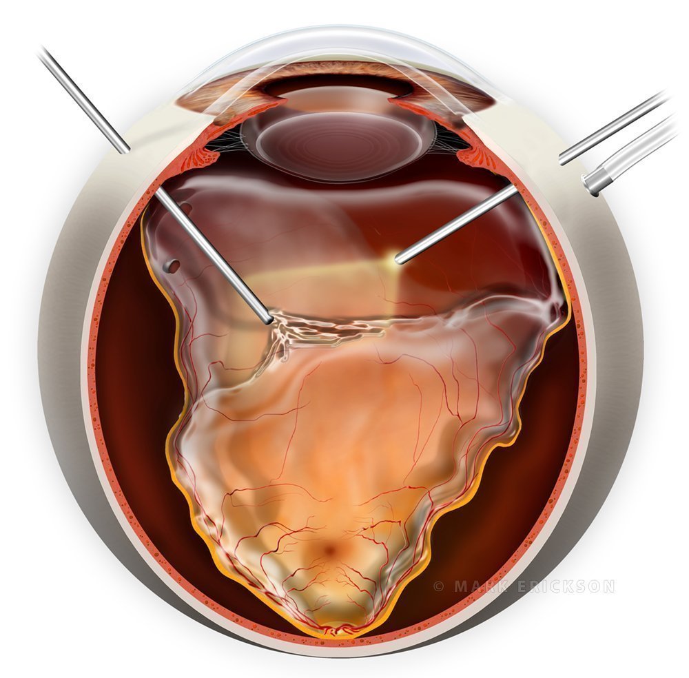 Pars plana vitrectomy with retinal detachment repair surgery