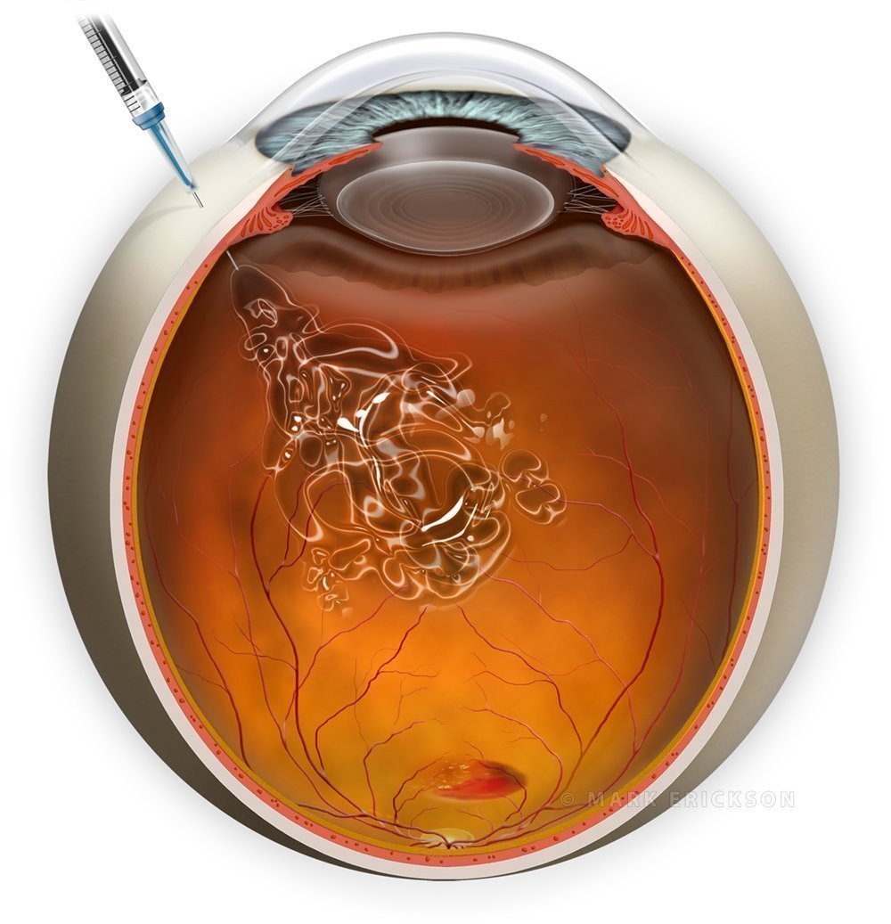 Intravitreal injection of anti-vegf for macular degeneration cross section eyeball