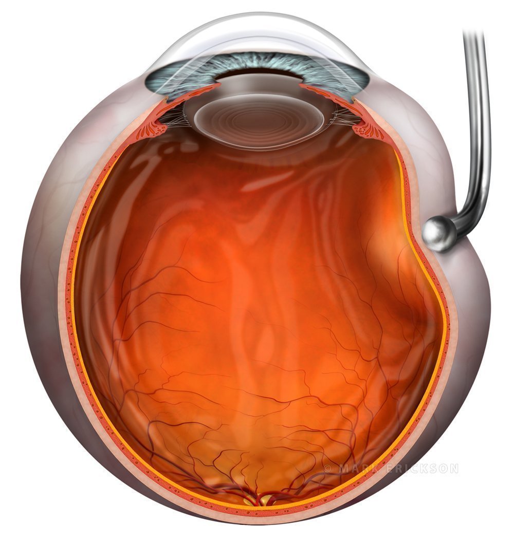 Scleral depression technique in ophthalmoscopy