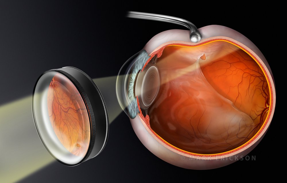 Scleral depression ophthalmoscopy artwork