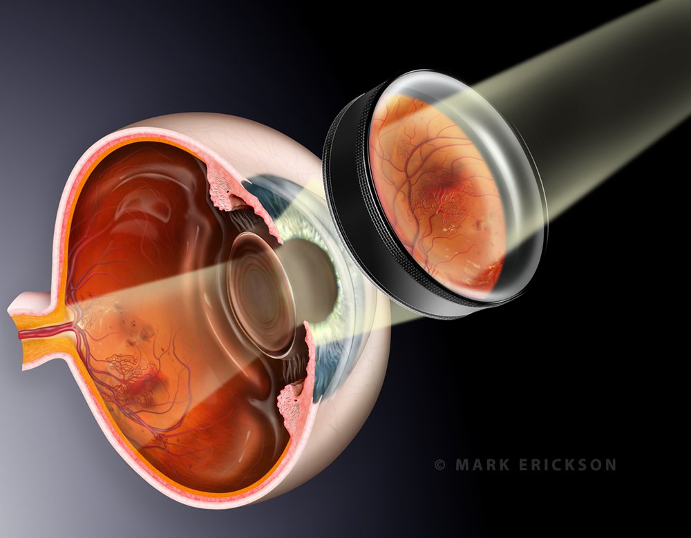 Ophthalmoscopy illustration