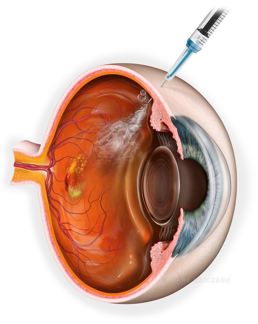 Intravitreal anti-vegf injection for wet macular degeneration, cross section illustration