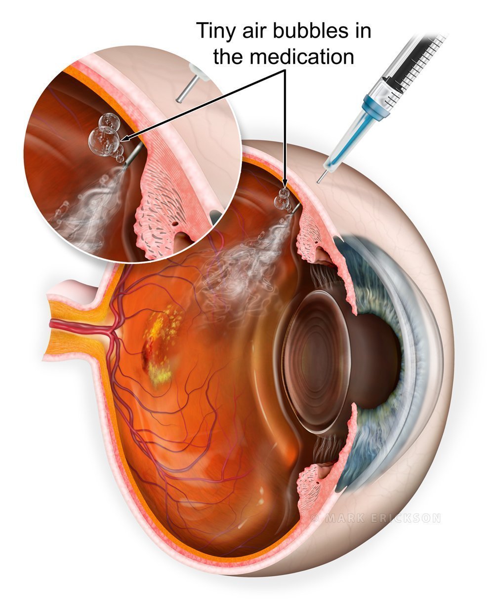 Cross section illustration of an intravitreal anti-vegf injection illustration explaining why the patient sees "bubbles"