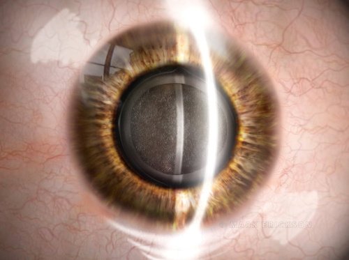 Posterior capsular opacification (PCO) eye illustration