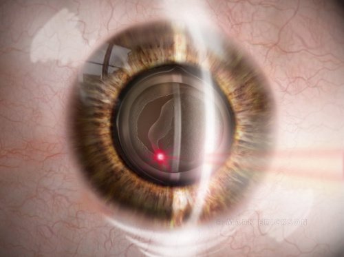 YAG laser capsulotomy patient education illustration