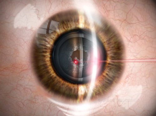 Stock eye surgery illustrations