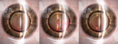 YAG laser capsulotomy illustration series