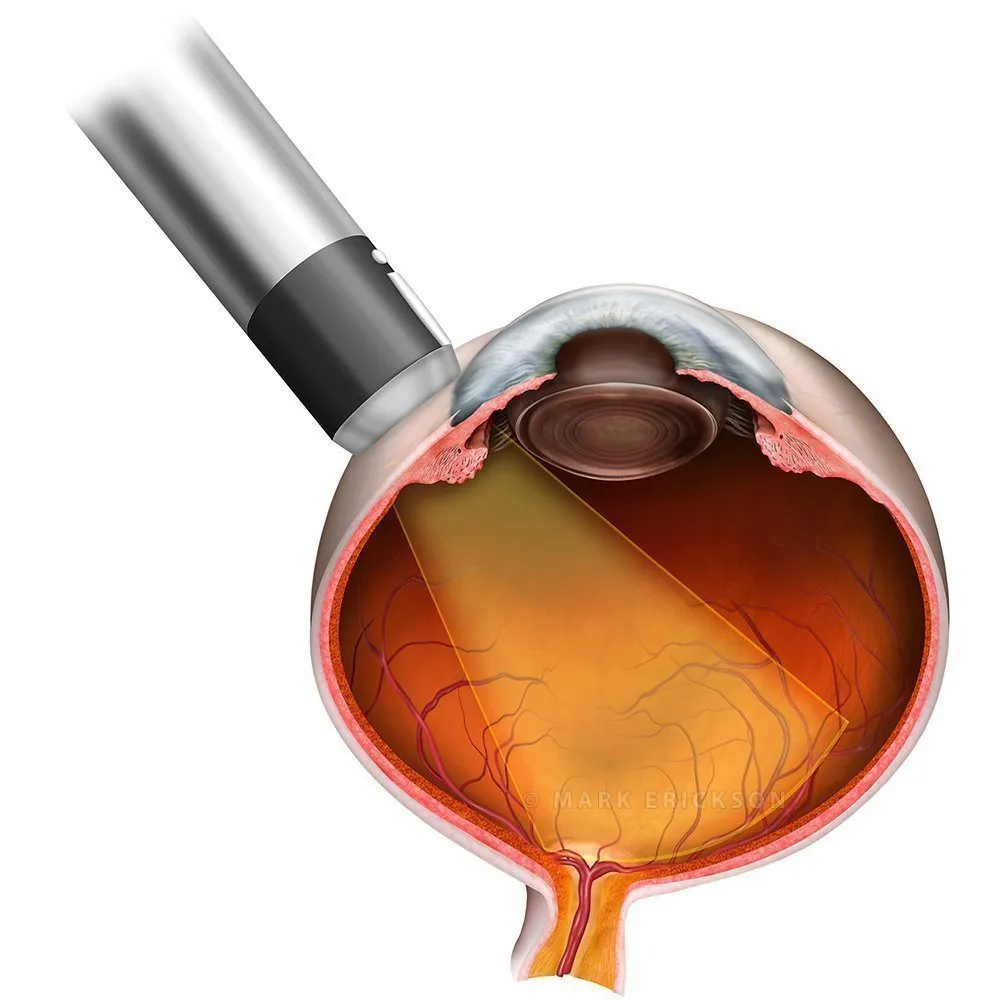 Ocular b-scan ultrasound longitudinal beam orientation | suvr3130b brvo Ocular ultrasound b-scan probe longitudinal beam