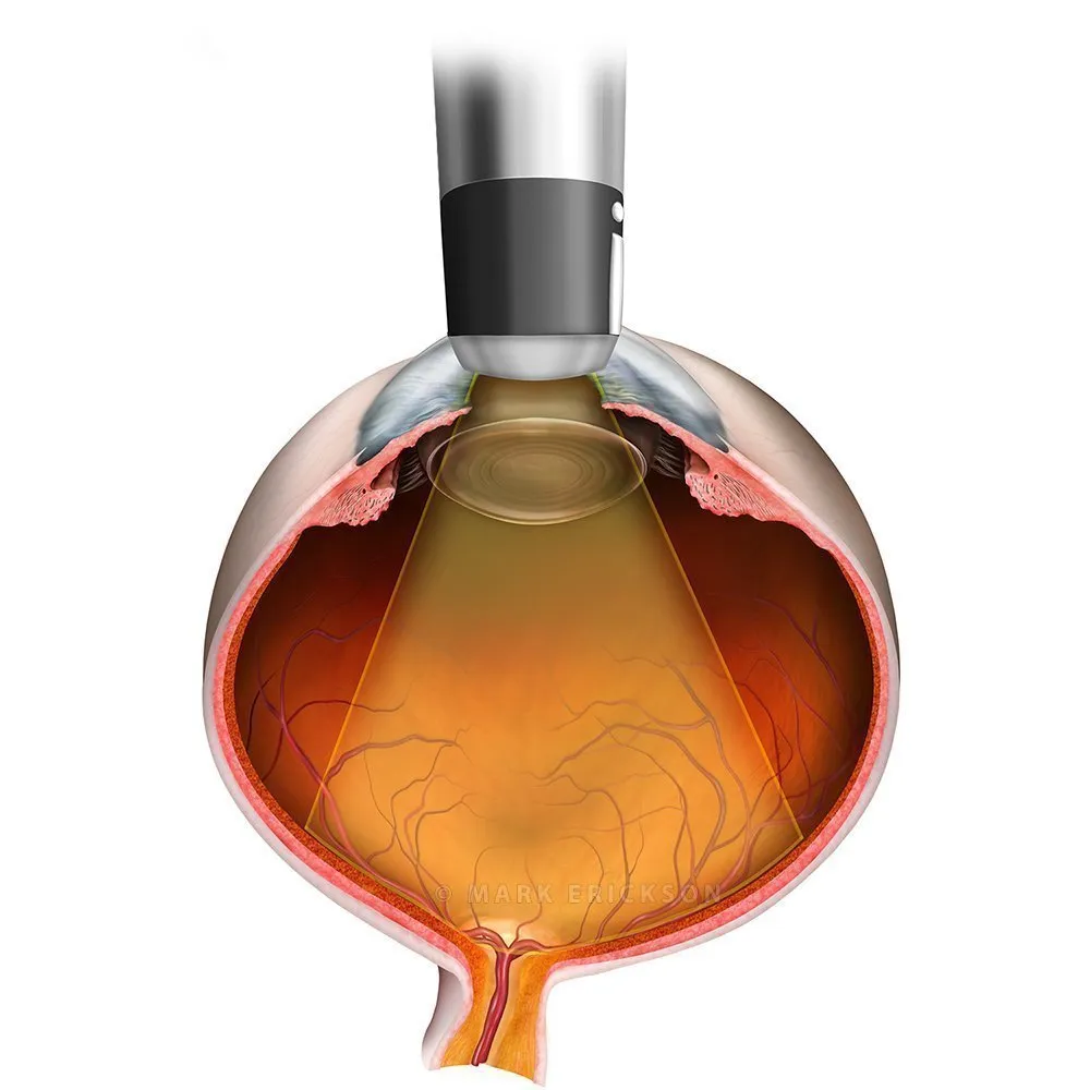 B-scan ocular ultrasound axial beam orientation image DOWNLOAD brvo B-scan ocular ultrasound axial beam orientation