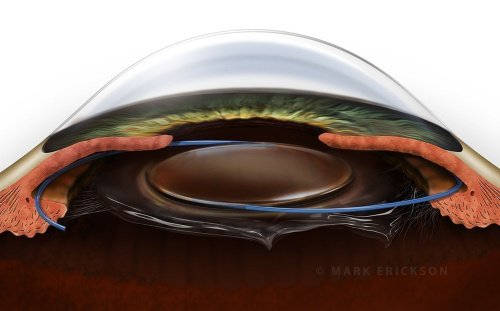 Ciliary sulcus IOL implant patient education illustration