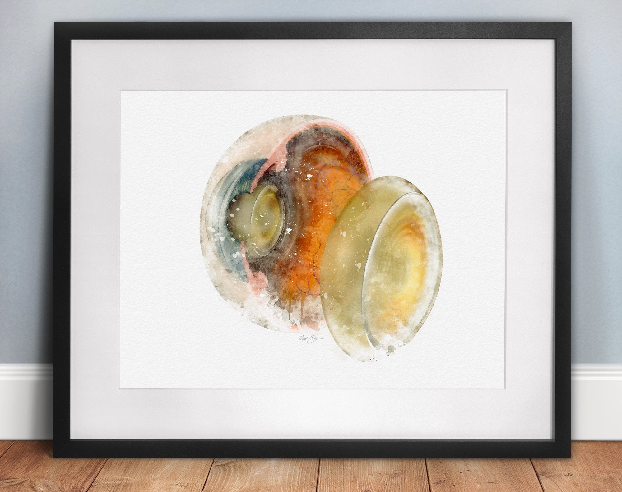 Cataract anatomy art print