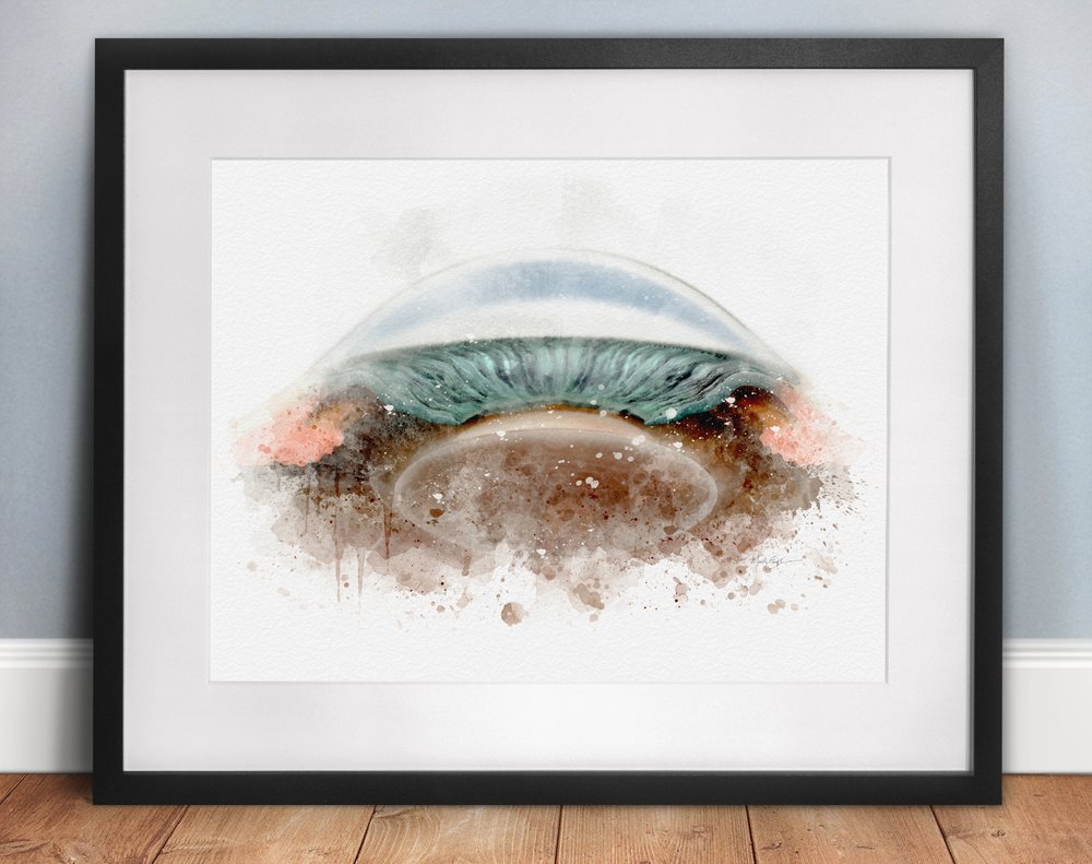Closed angle glaucoma art print