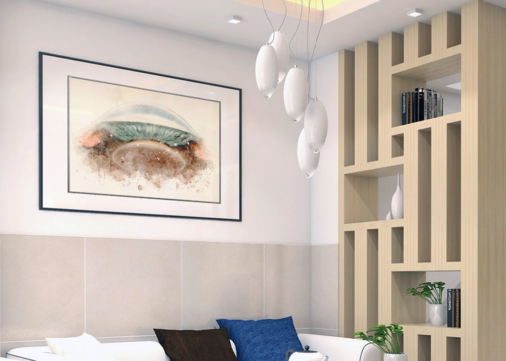 Glaucoma art print featuring detailed closed-angle anatomy - 076 glaucoma art print Optometrist wall art gift