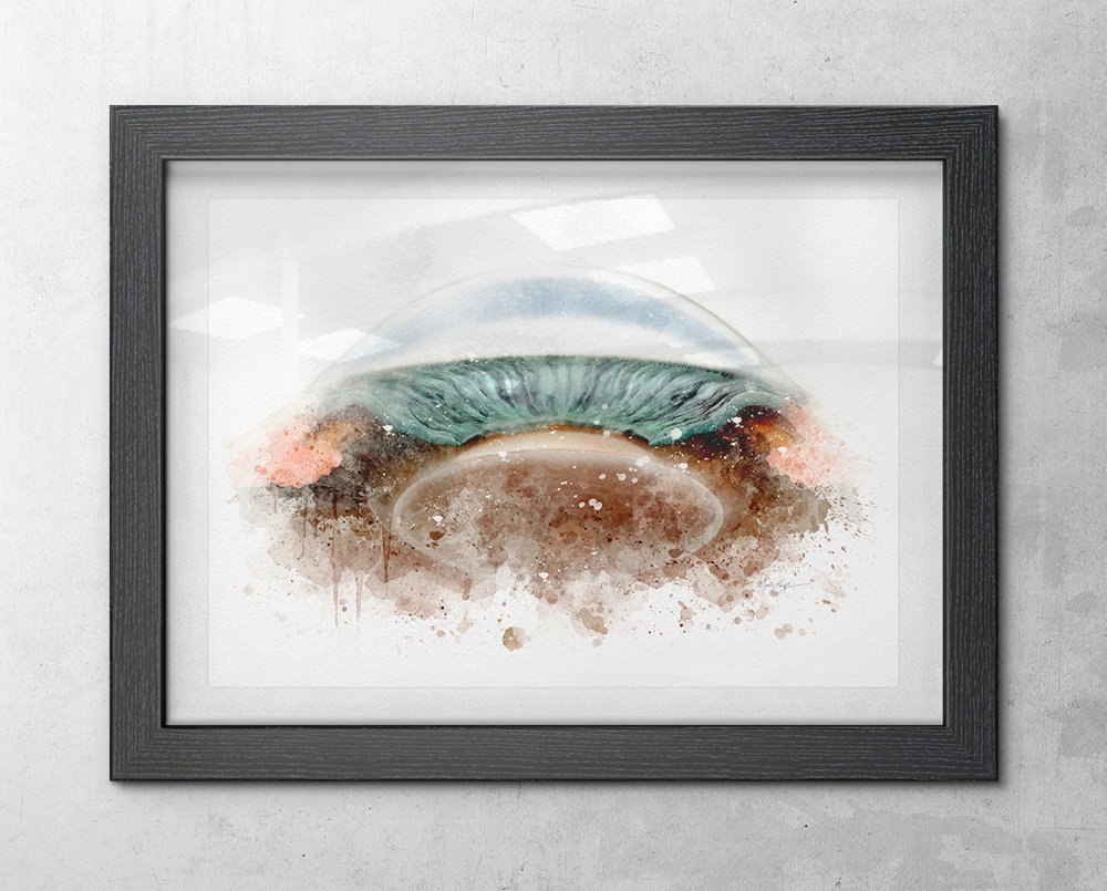 Glaucoma art print featuring detailed closed-angle anatomy - 076 glaucoma art print Glaucoma specialist art gift