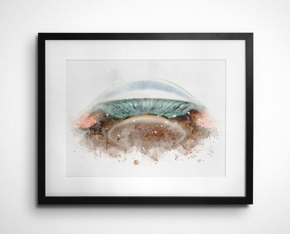 Glaucoma art print featuring detailed closed-angle anatomy - 076 glaucoma art print Glaucoma doctor gift