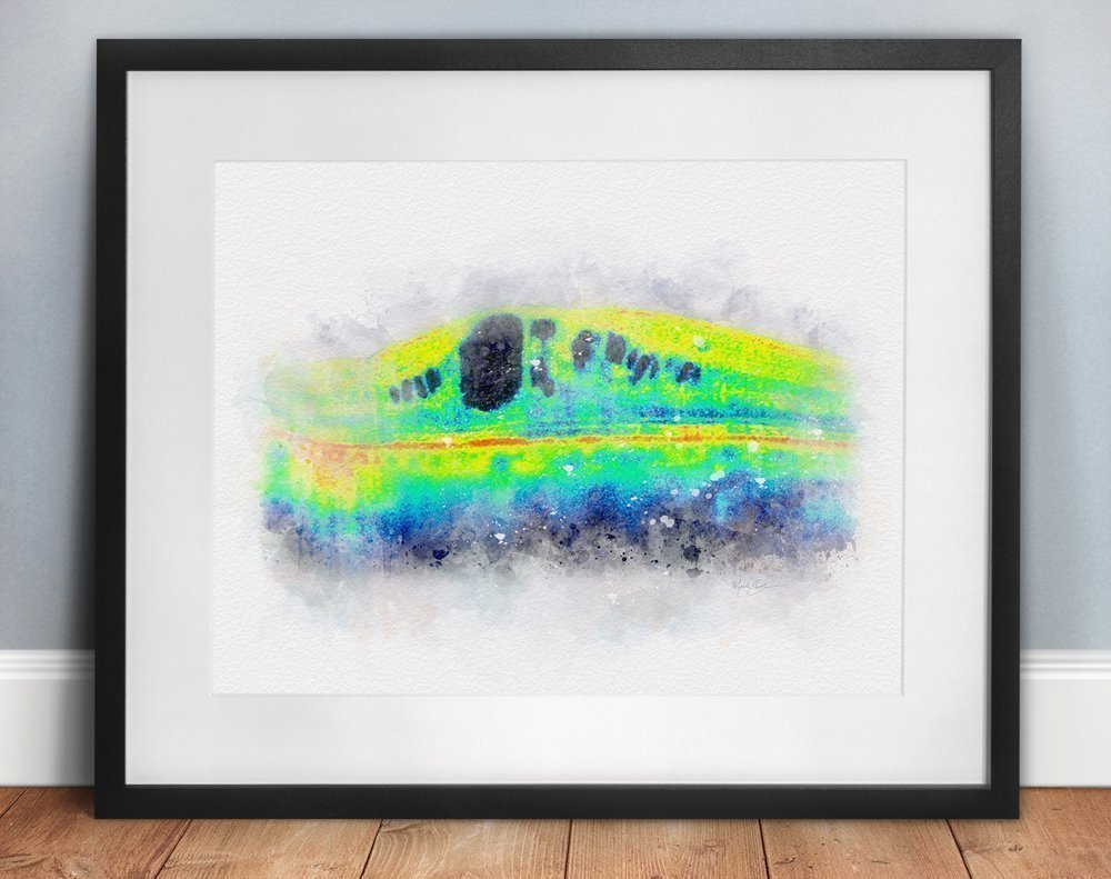 OCT diabetic macular edema art print