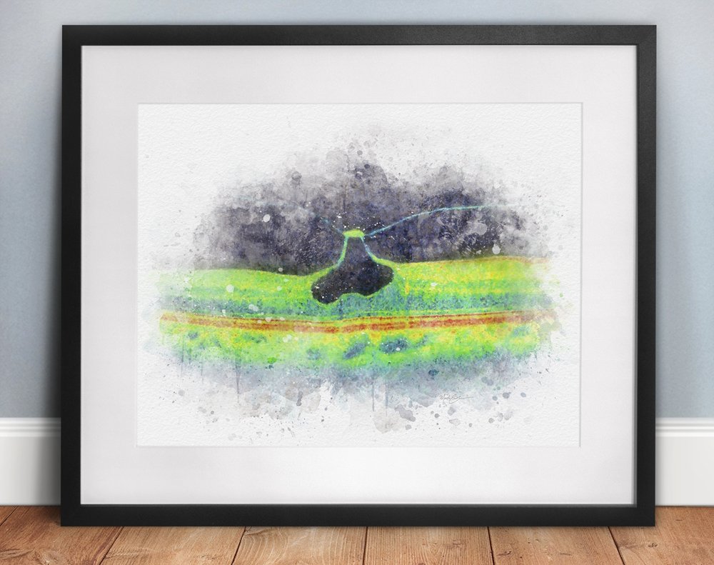 OCT vitreomacular traction art print