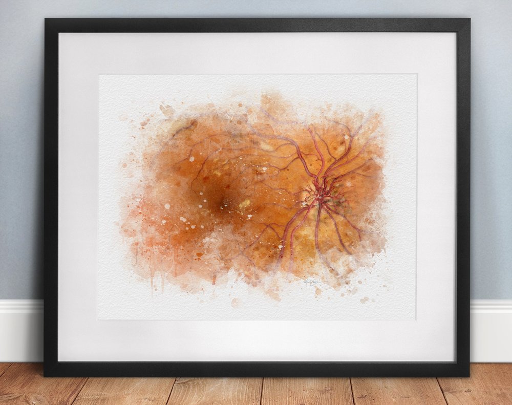 Diabetic retinopathy art print - 204 optic nerve cupping Diabetic retinopathy art print gift for a retina specialist