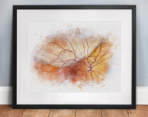 Retinal detachment wall art print