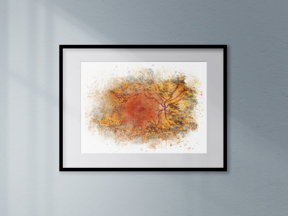 Retinitis pigmentosa art print - 301 retinitis pigmentosa Retina doctor's office decor
