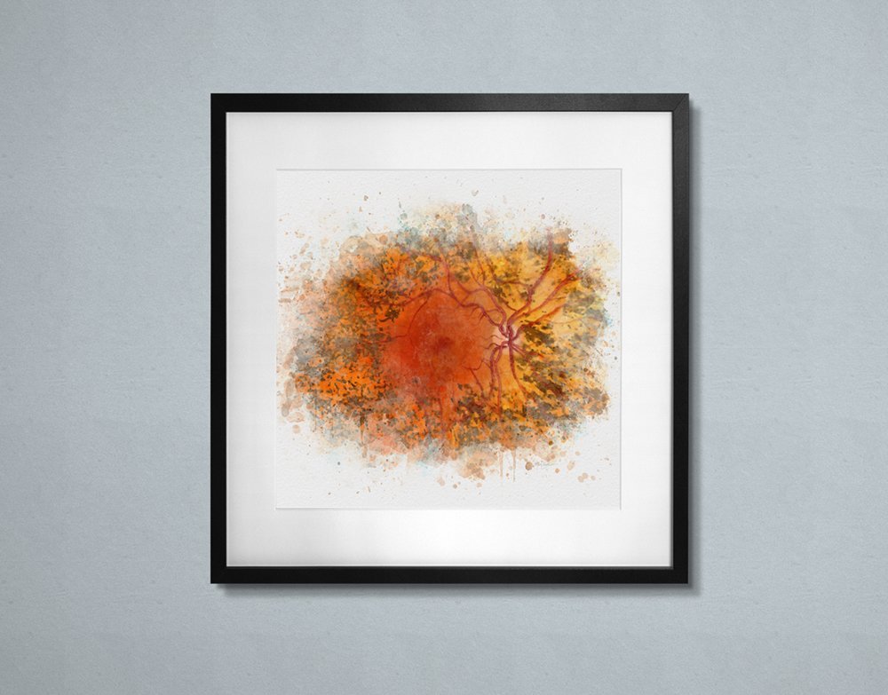 Retinitis pigmentosa art print - 301 retinitis pigmentosa Usher syndrome art