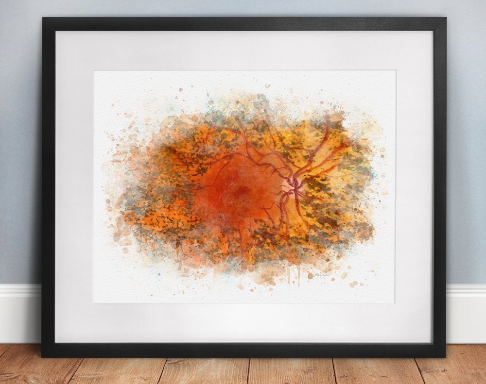 Retinitis pigmentosa art print gift for an eye doctor
